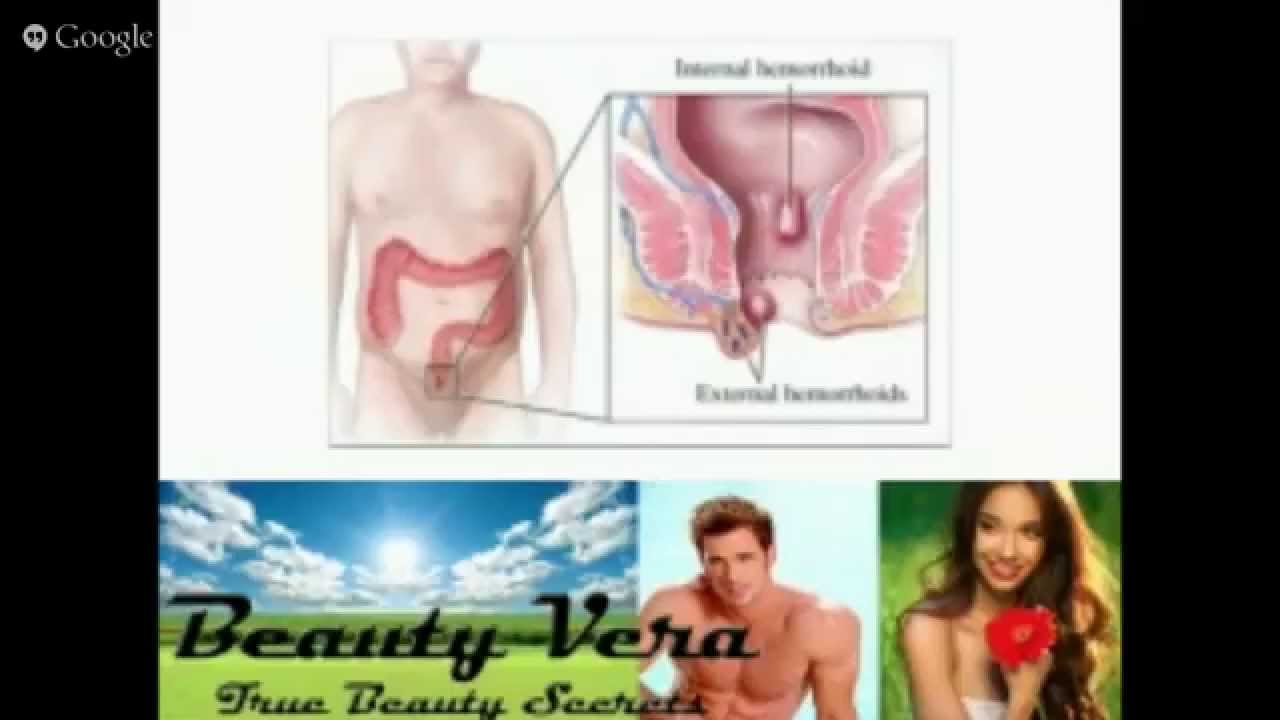 Hemorroids Treatment