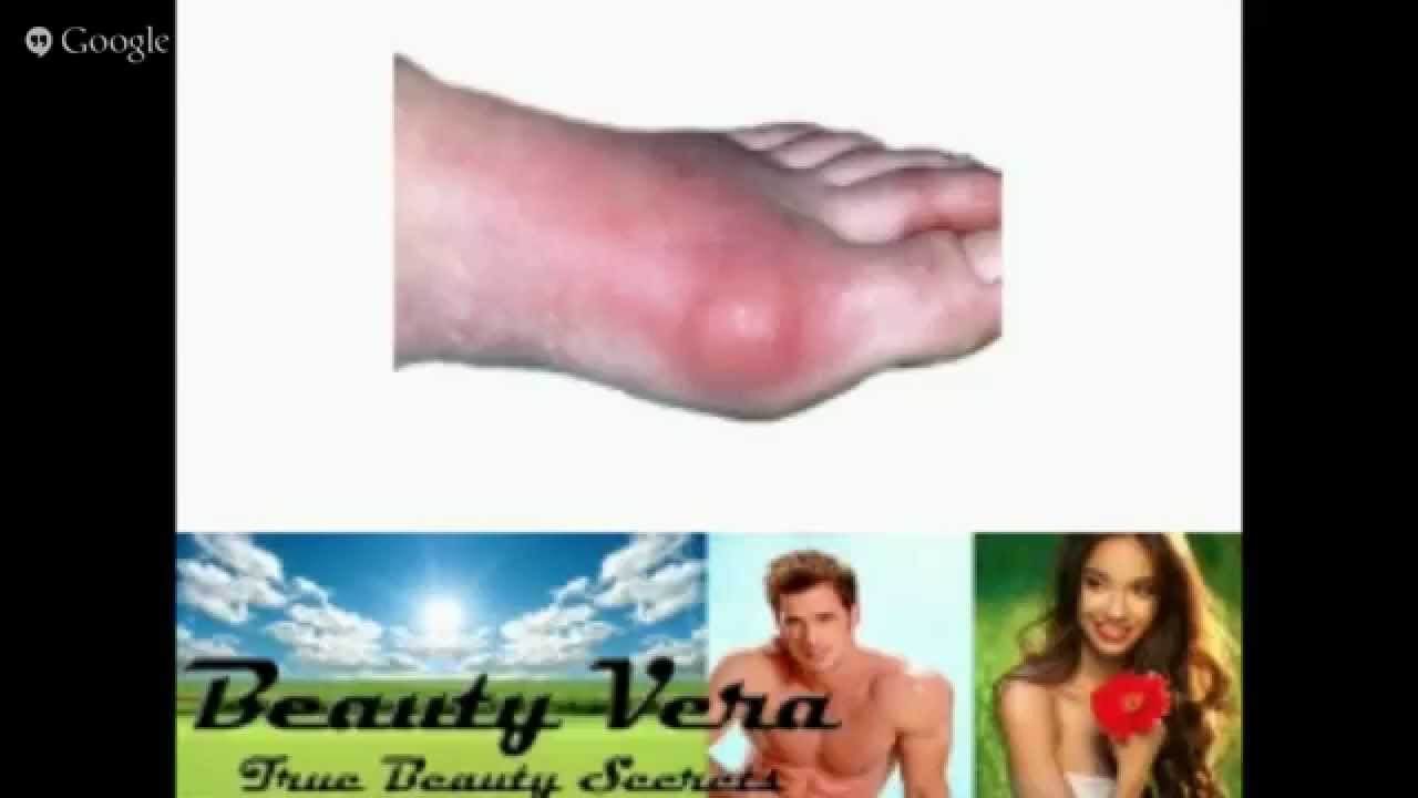 Gout Symptoms